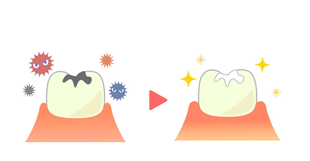 ドックスベストセメント治療